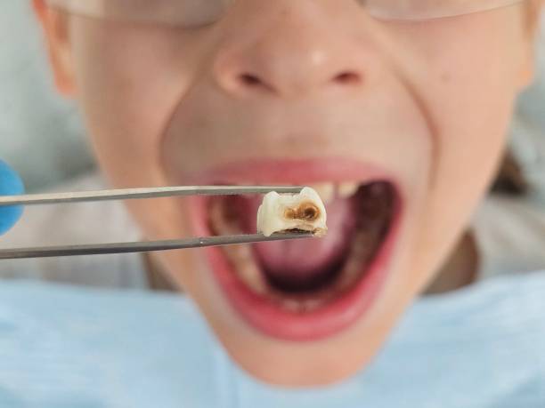 Best Broken or Cracked Tooth Emergency Dentist in Hemlock Farms, PA